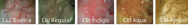 Comparação entre luz branca e os 4 modos de cromoendoscopia CBI da Aohua